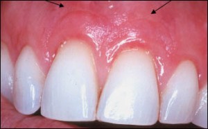 Root Coverage. Note hint of Incision Line. (arrows).