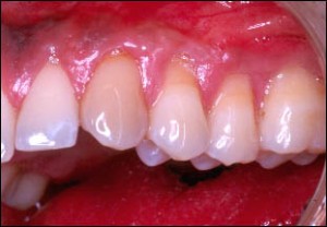 Final Healing (See arrows in initial photo for final gum positions)