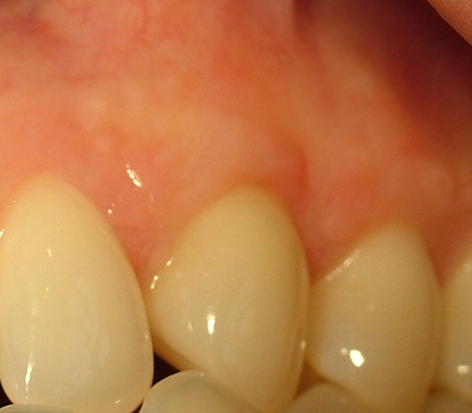 Final Healing (Two Months)